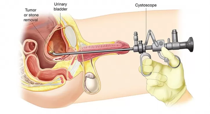 Sistoskopi Nedir
